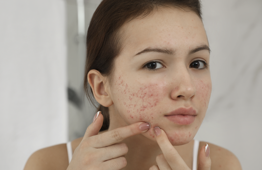 Why Teenagers Need A Skincare Routine